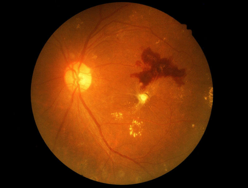 retinopatia-cukrzycowa